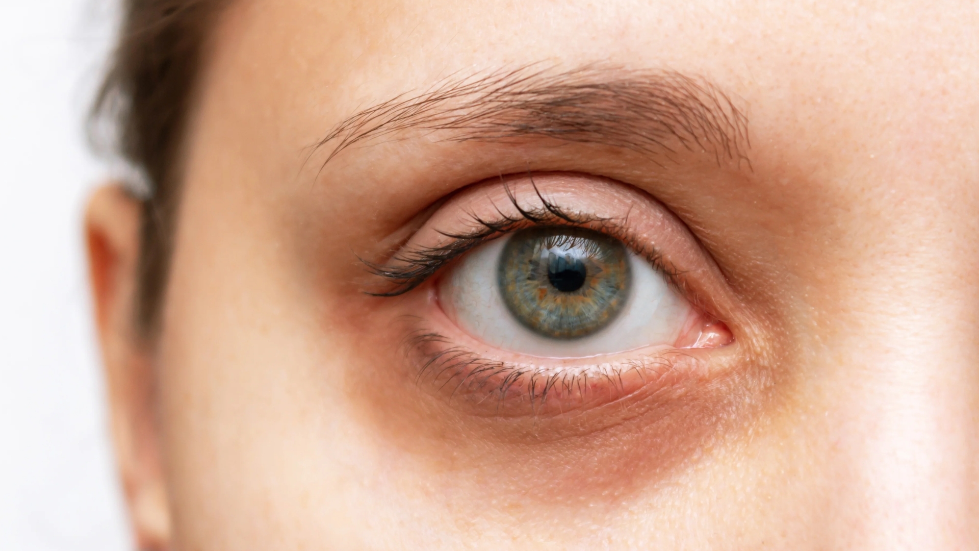 Dark Circles