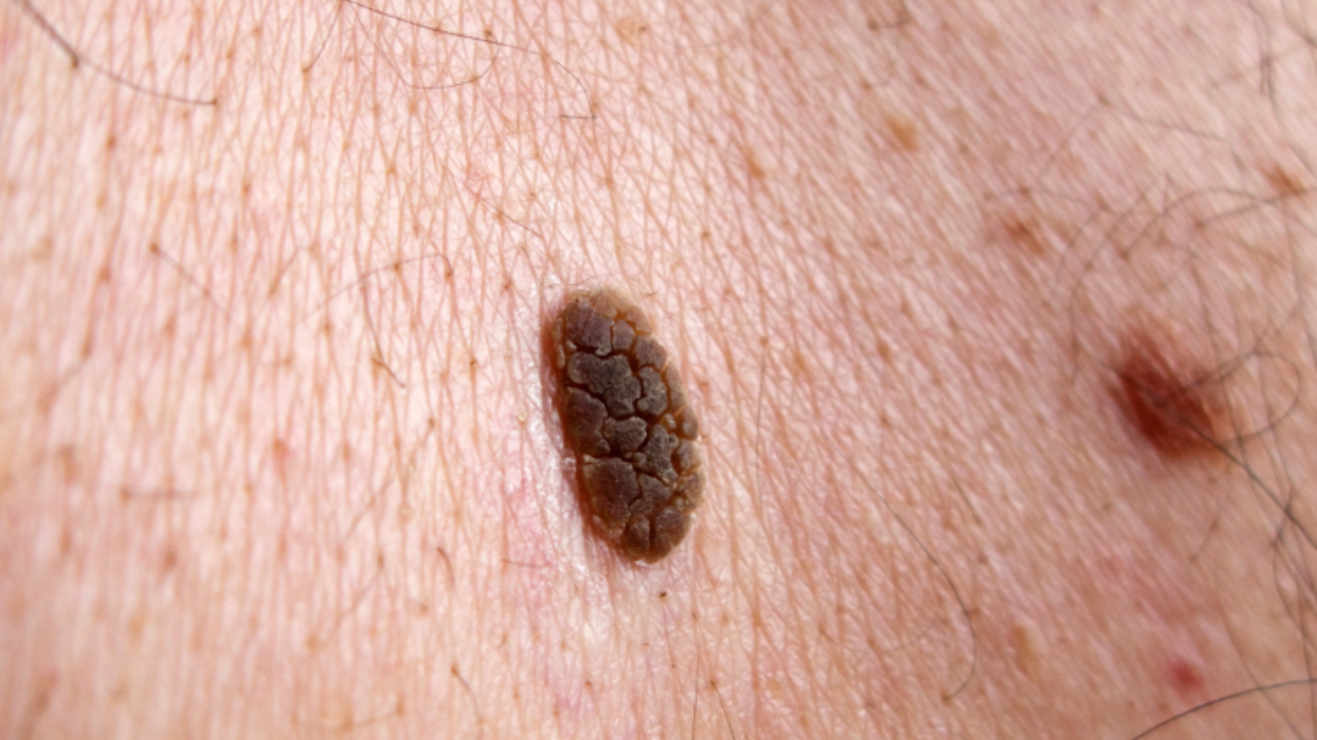 Seborrhoeic Keratosis