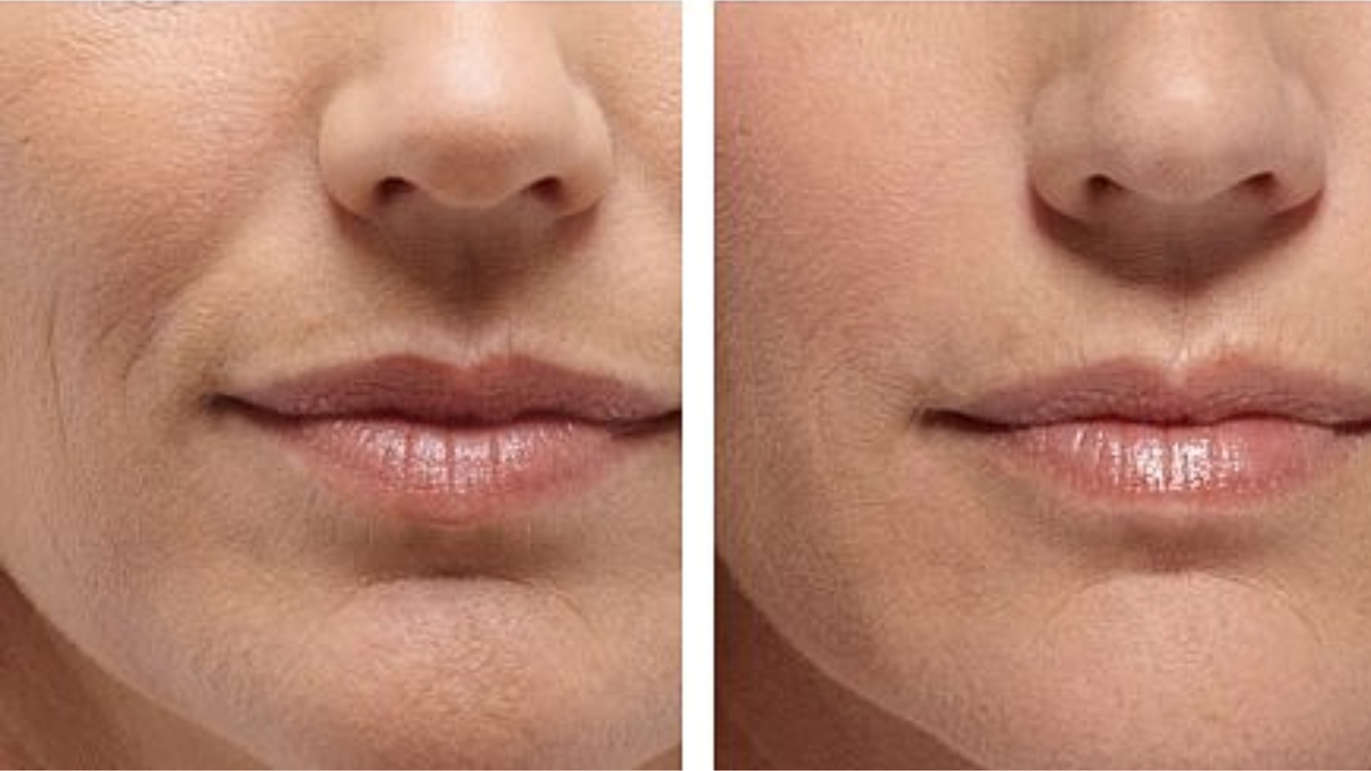 Mouth to Chin Lines