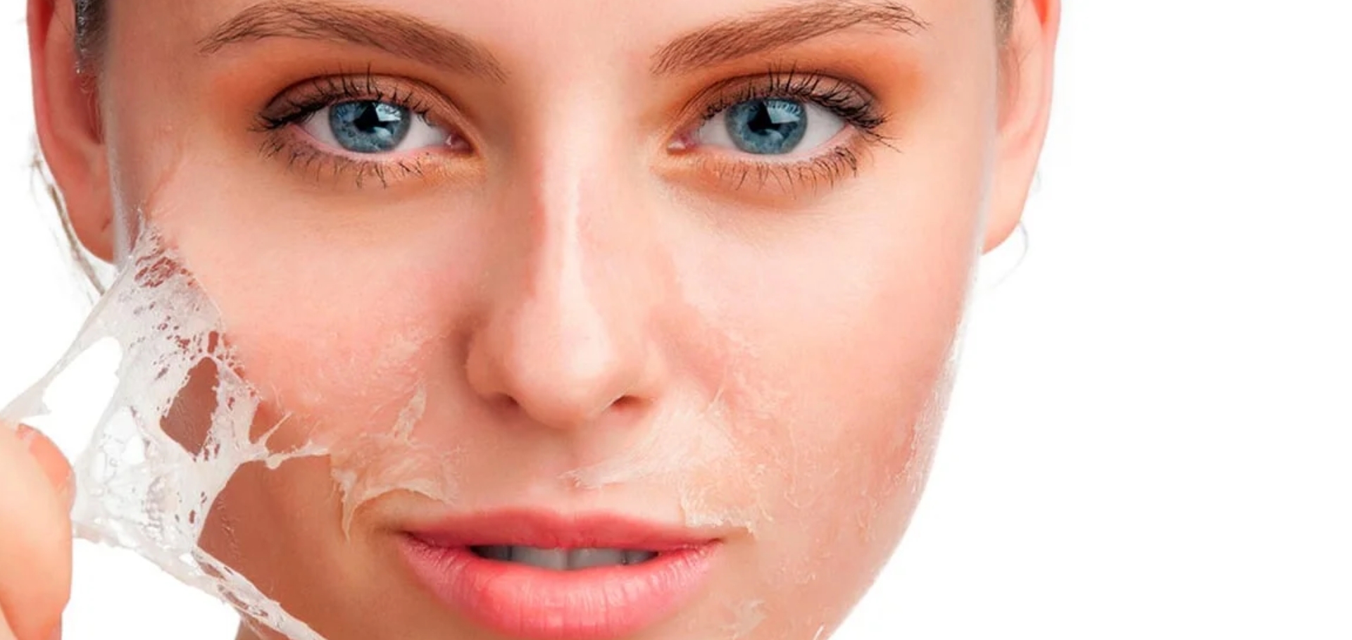 Chemical Peels