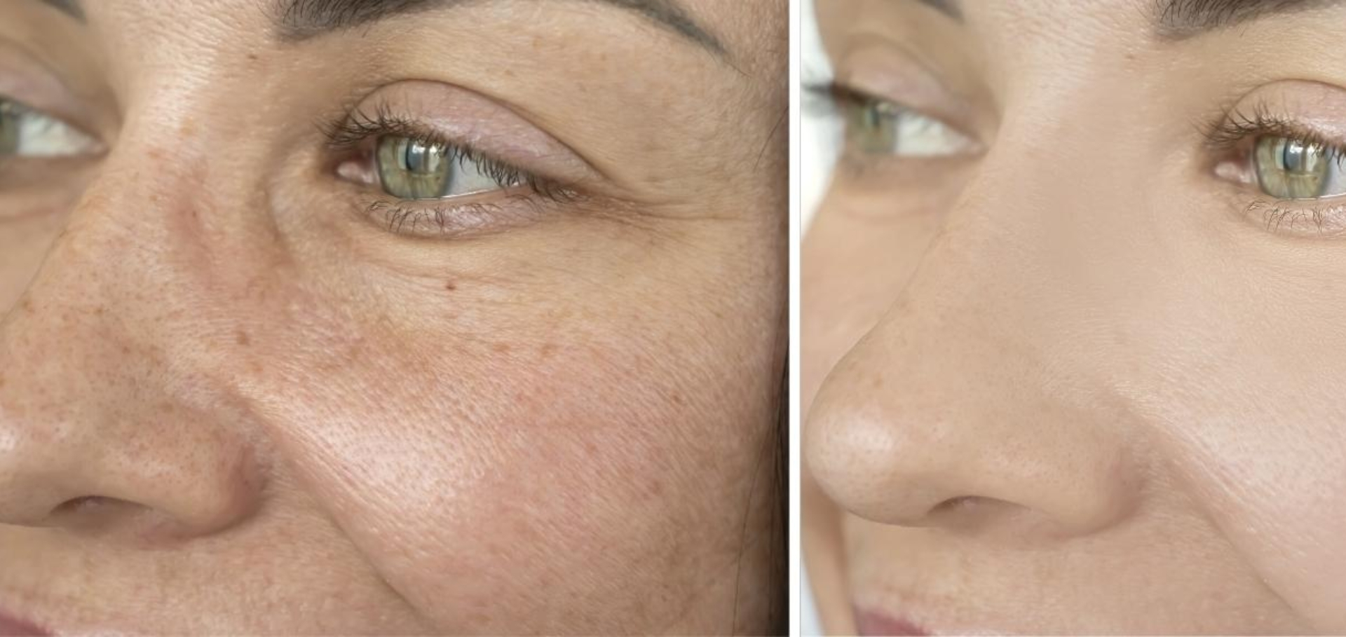 Illumifacial